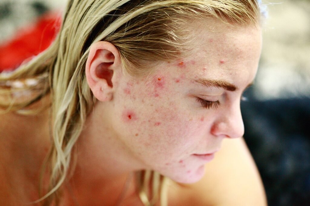 Woman with acne skin